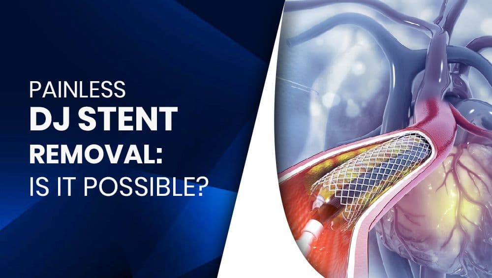Painless DJ Stent Removal: Is It Possible?