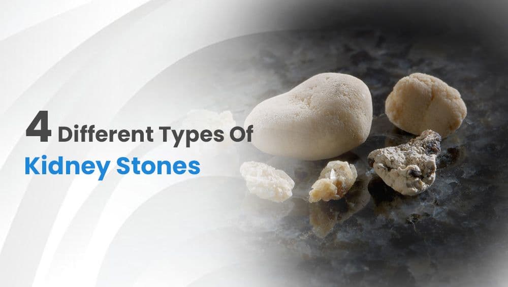 4 Different Types Of Kidney Stones