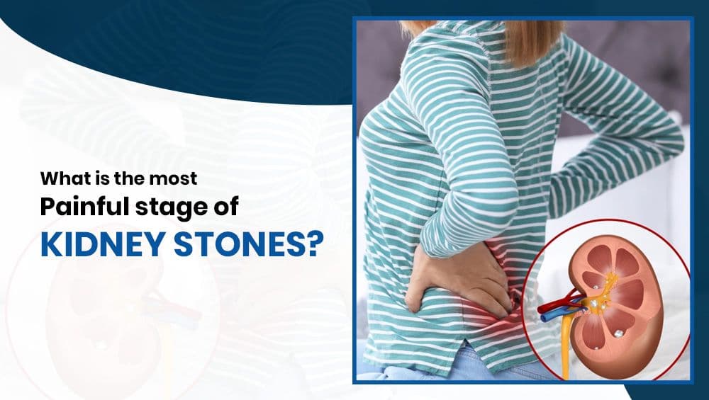 What is the most painful stage of kidney stones?