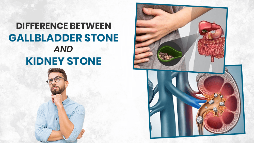 Difference Between Gallbladder Stone and Kidney Stone