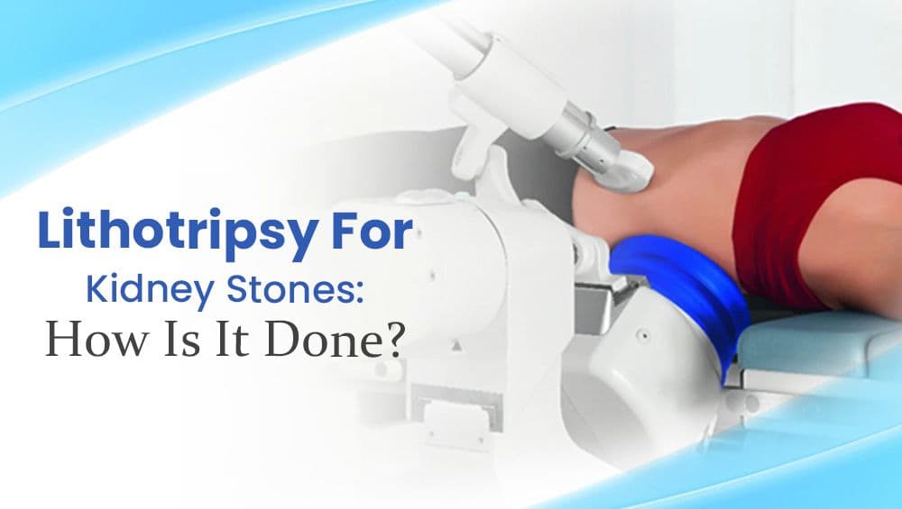 Lithotripsy For Kidney Stones: How Is It Done?