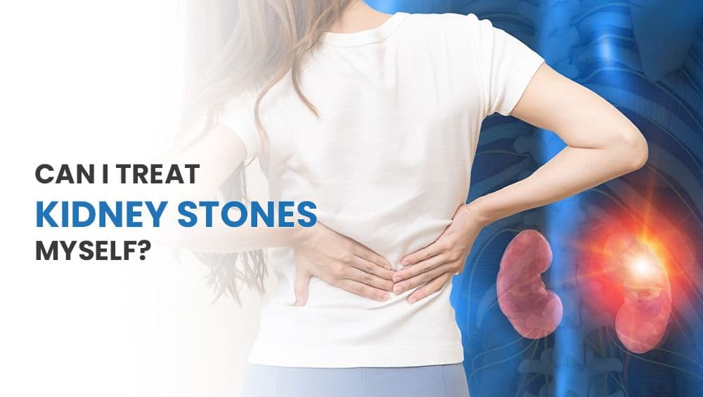 Can I Treat Kidney Stones Myself?