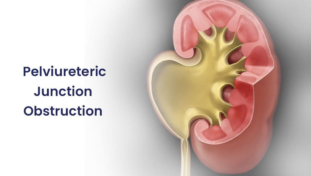 Pelvi-ureteric junction obstruction (PUJO)