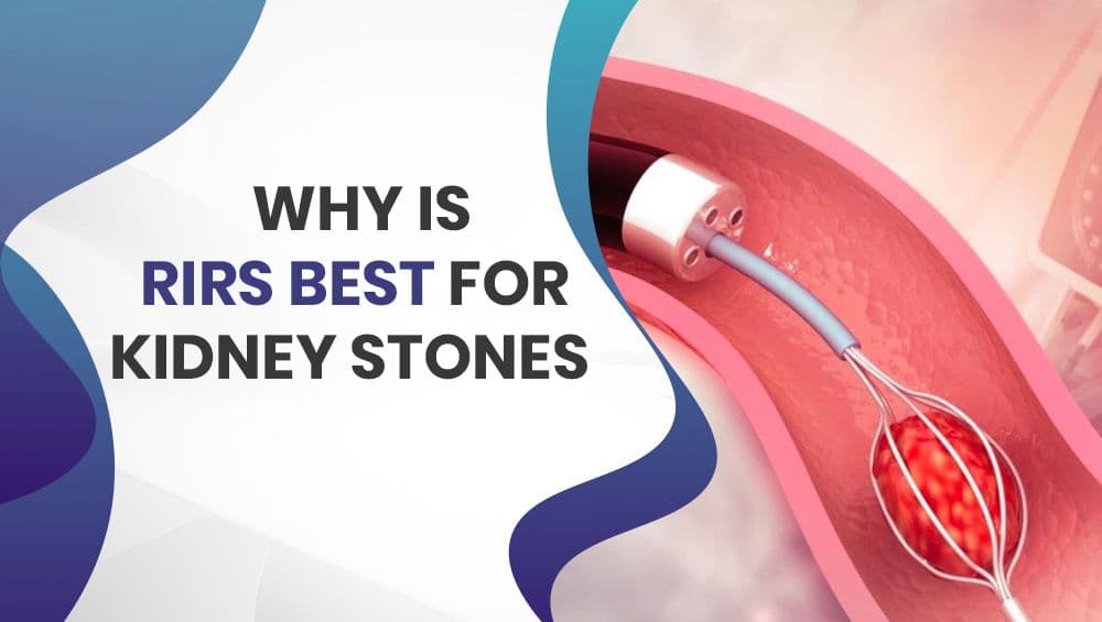Why is RIRS best for kidney stones?