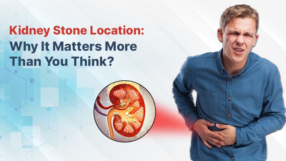 Kidney Stone Location: Why It Matters More Than You Think