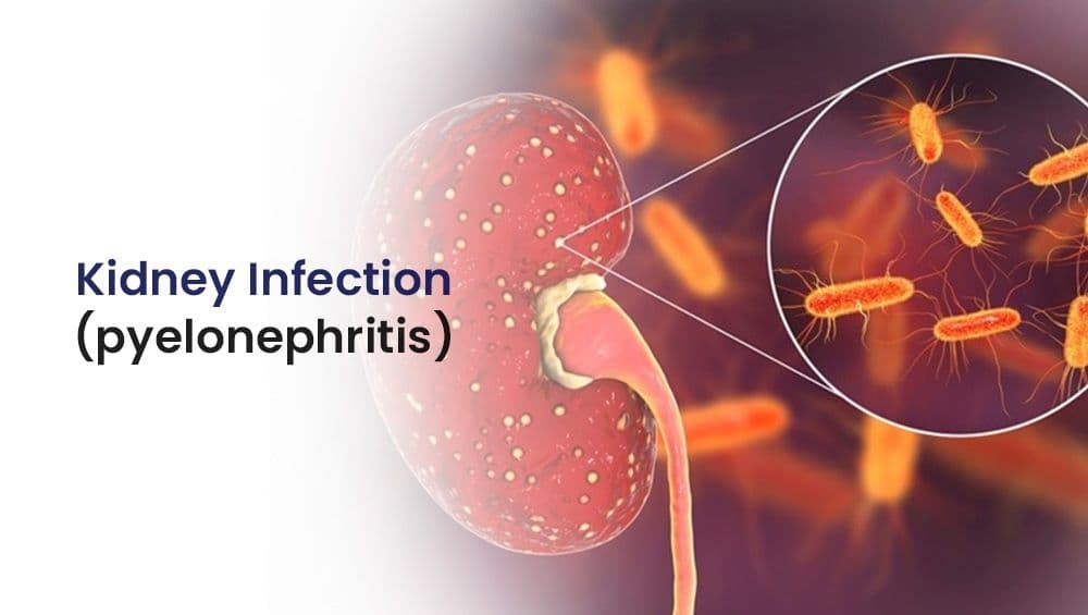 What is Kidney Infection? (Pyelonephritis)