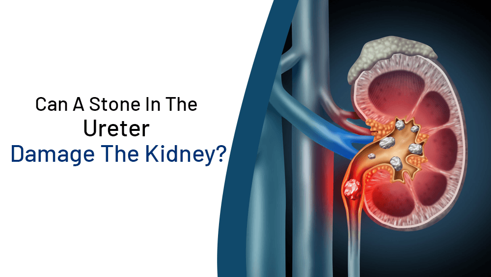 Can A Stone In The Ureter Damage The Kidney?