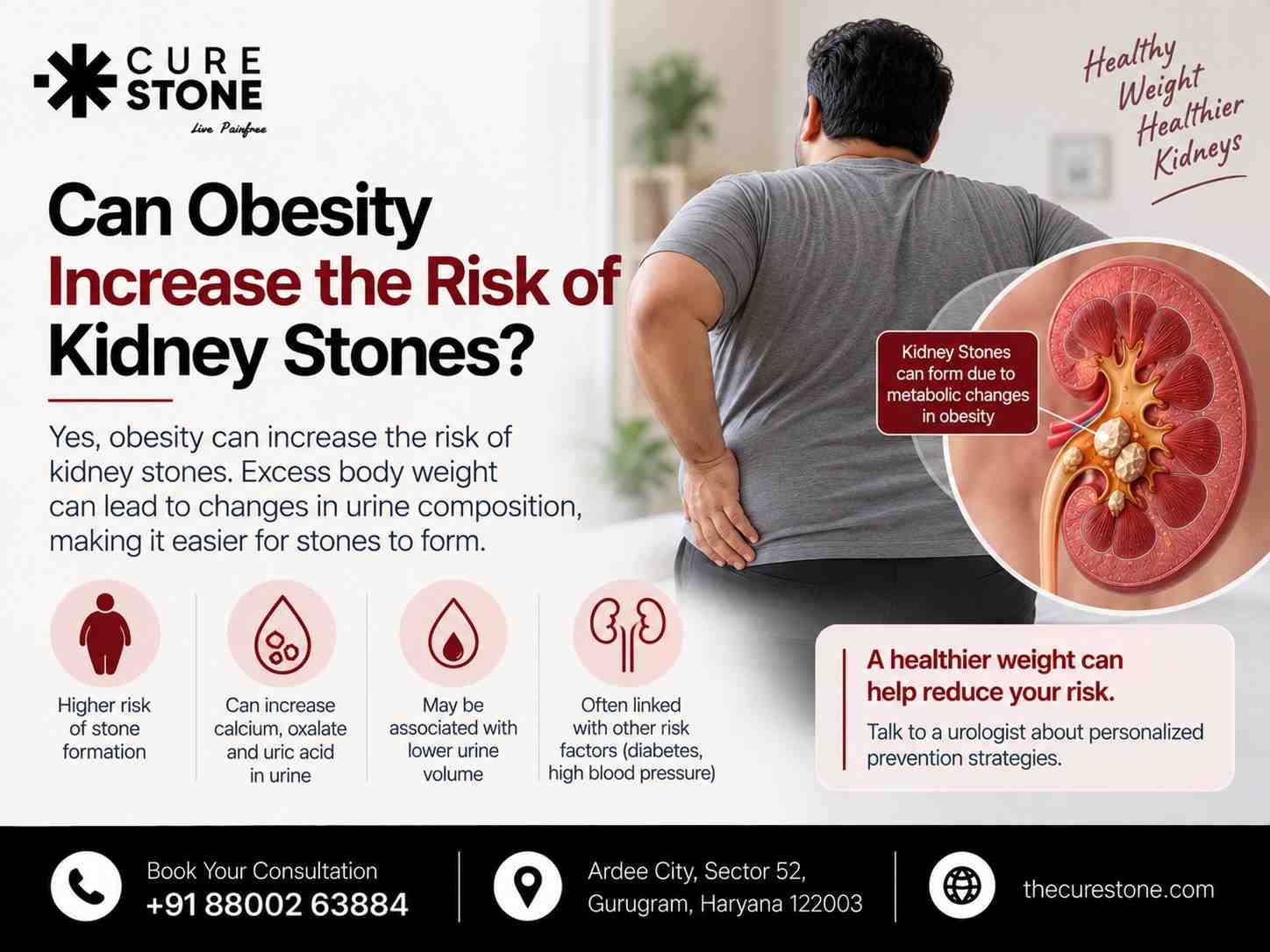 Can Obesity Increase the Risk of Kidney Stones?