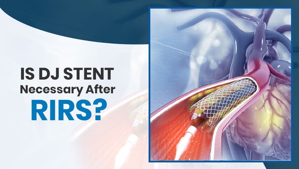 Is DJ Stent Necessary After RIRS?