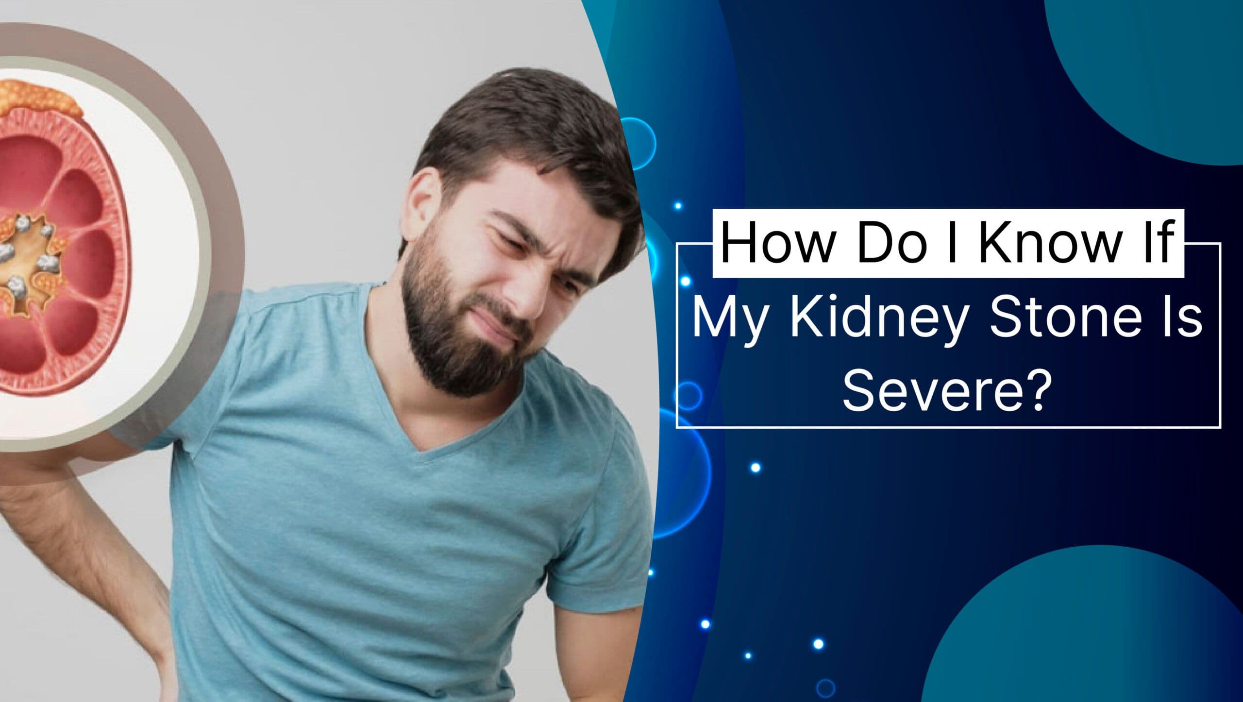How Do I Know If My Kidney Stone Is Severe?