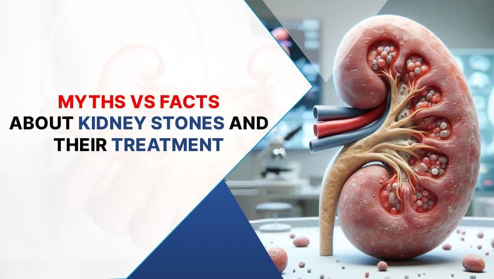 10 Myths vs Facts About Kidney Stones & Treatment
