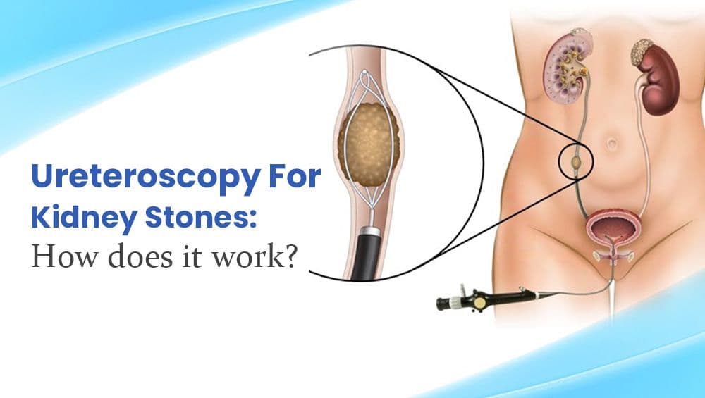 Ureteroscopy For Kidney Stones: How does it work?