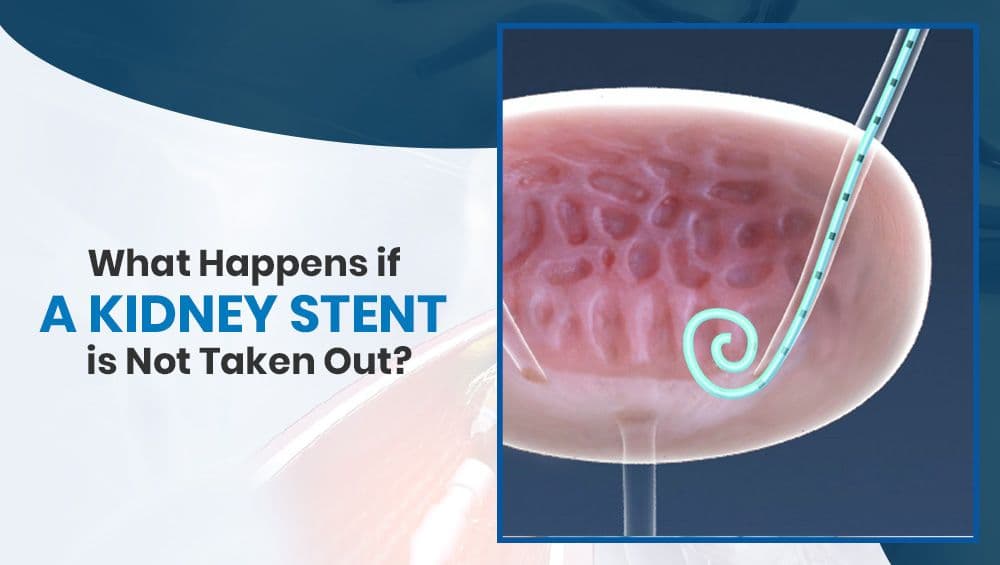 What Happens if a Kidney Stent is Not Taken Out?