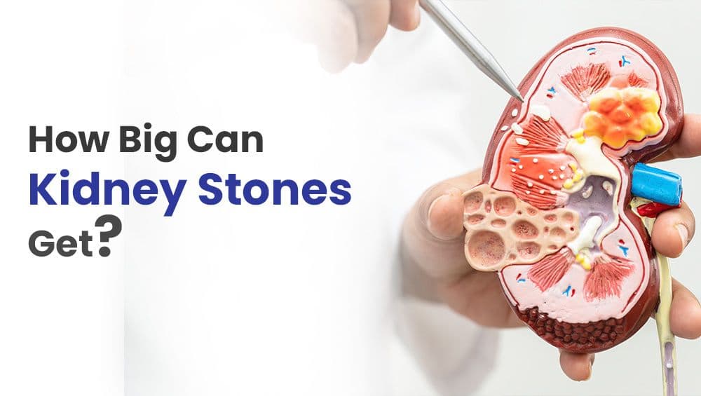 How Big Can Kidney Stones Get?