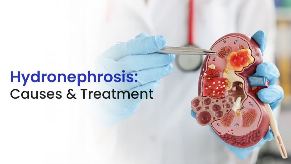 Hydronephrosis: Causes & Treatment