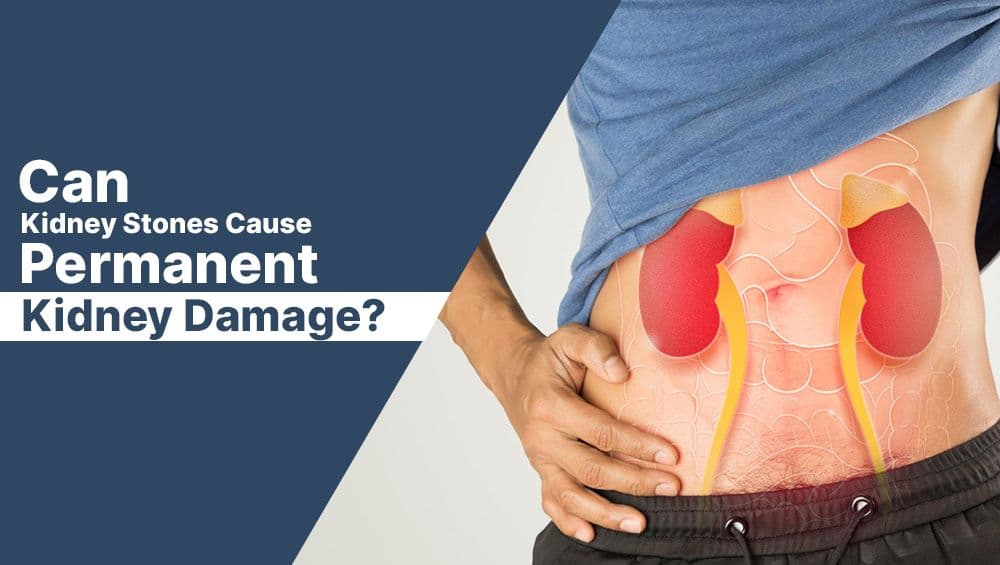 Can Kidney Stones Cause Permanent Kidney Damage?