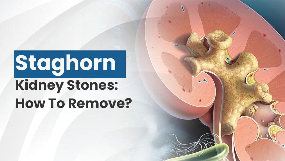 Staghorn Kidney Stones: How To Remove?