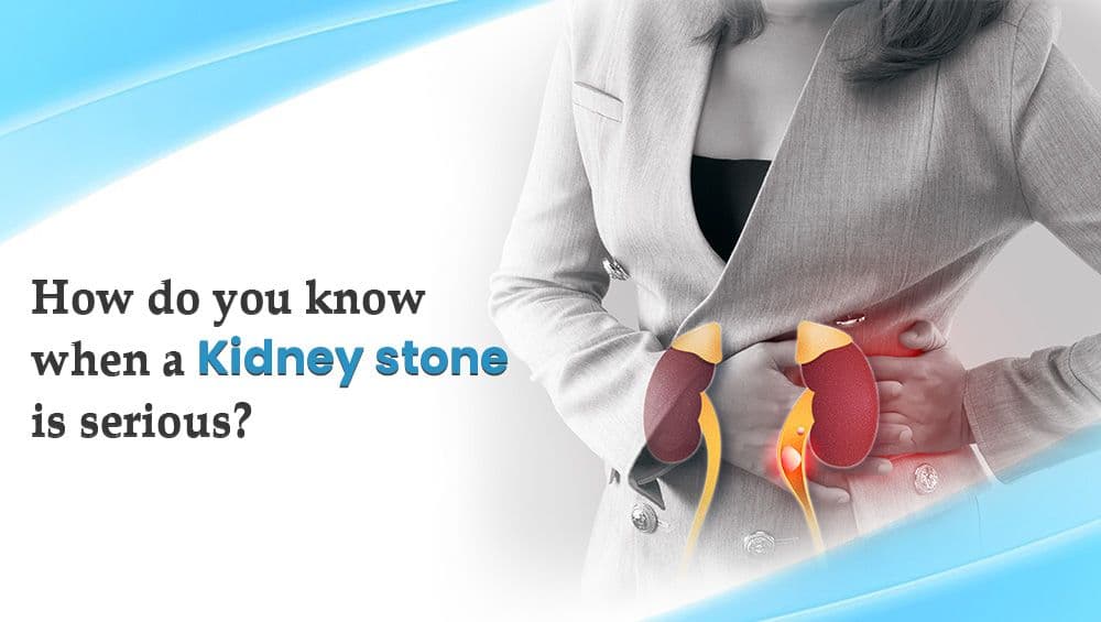How do you know when a kidney stone is serious?