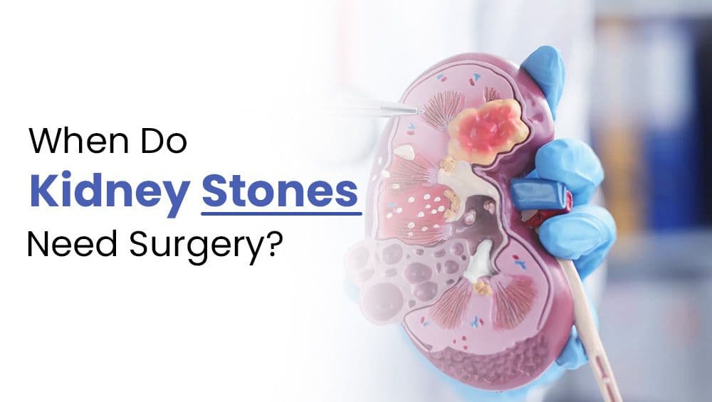 When Do Kidney Stones Need Surgery?