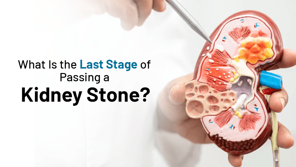 What Is the Last Stage of Passing a Kidney Stone?