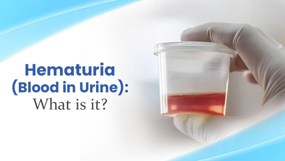 Hematuria (Blood in Urine): What is it?