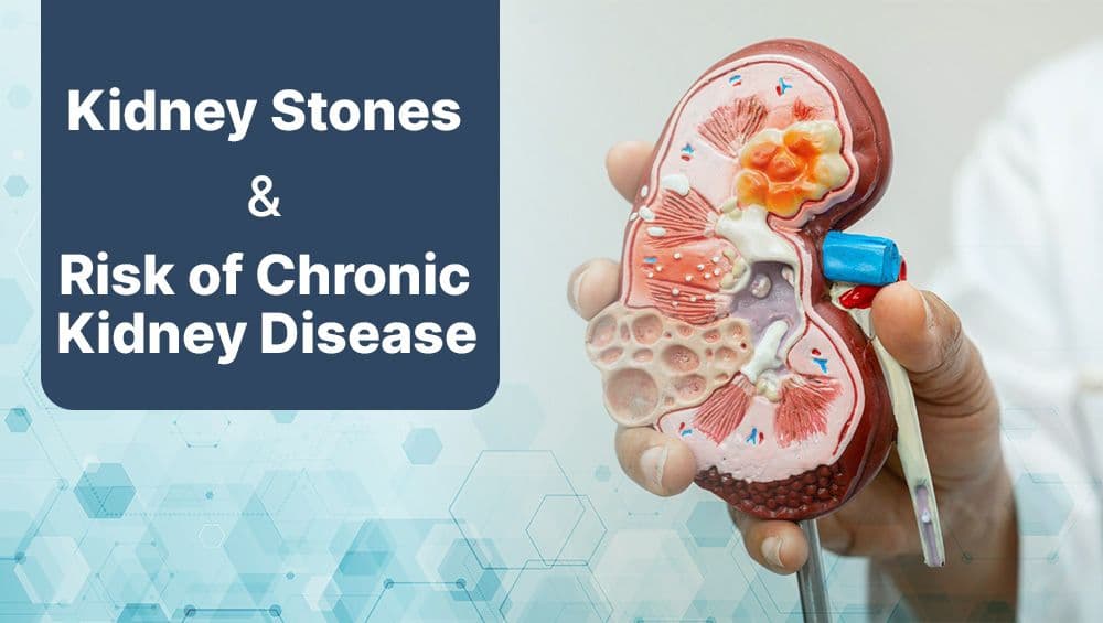 Kidney Stones & the Risk of Chronic Kidney Disease