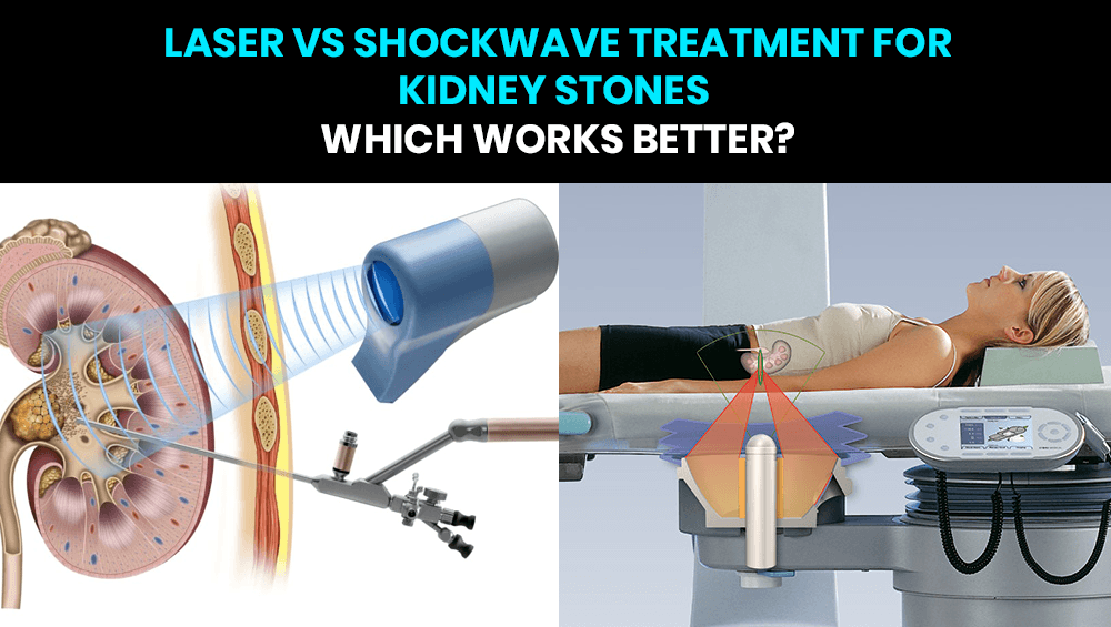 Laser vs shockwave treatment for kidney stones – Which works better?