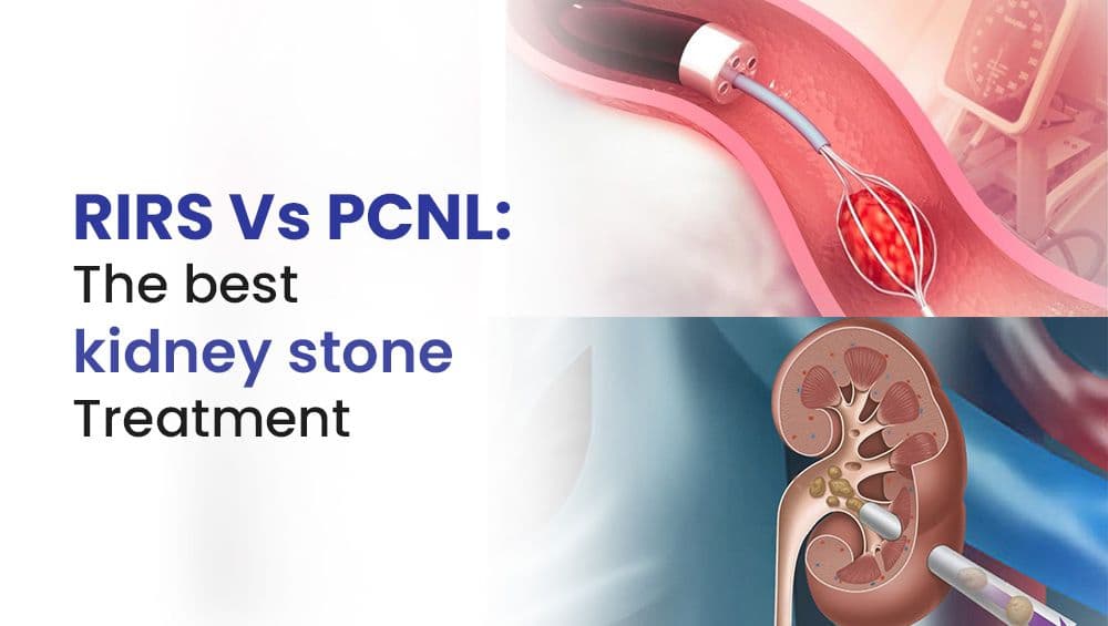 RIRS Vs PCNL: The best kidney stone Treatment