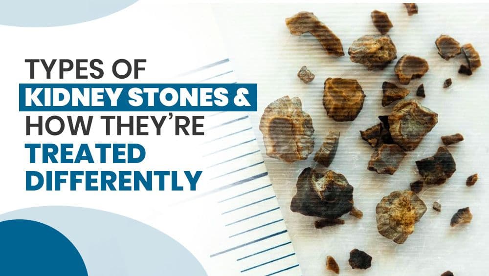 Types of Kidney Stones & How They’re Treated Differently