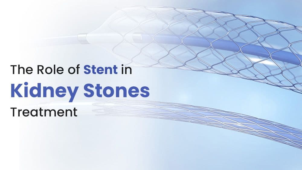 The Role of Stent in Kidney Stone Treatment