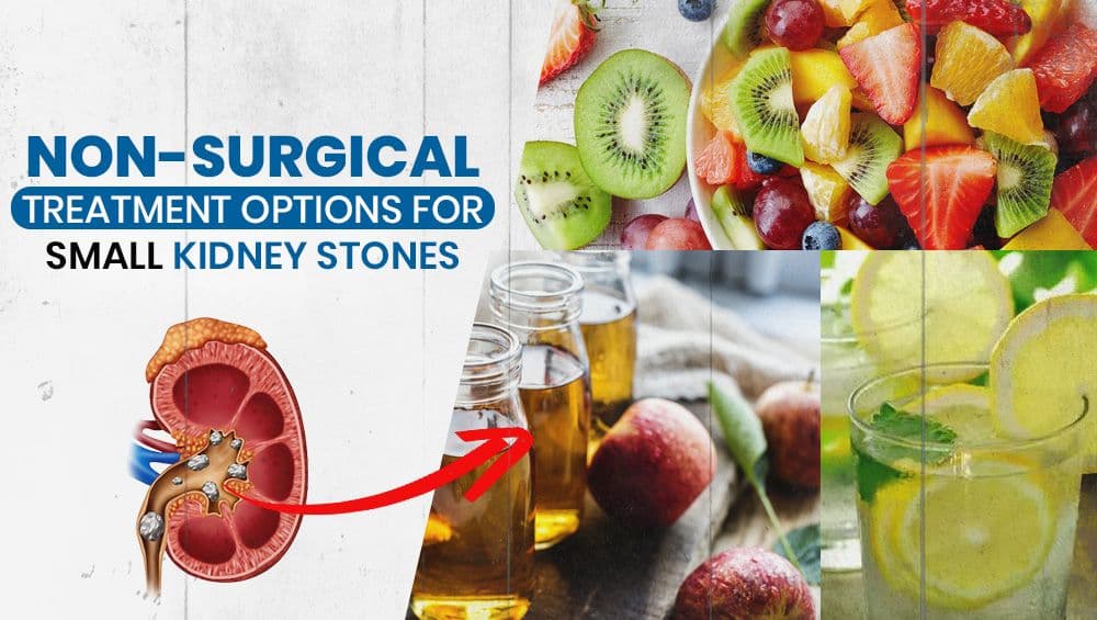 Non-Surgical Treatment Options for Small Kidney Stones