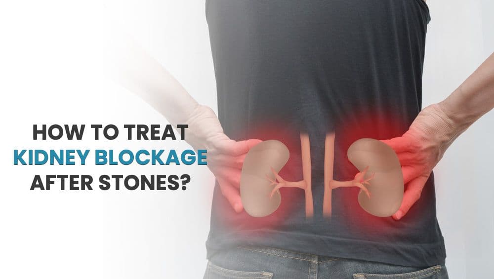 How to Treat Kidney Blockage After Stones?