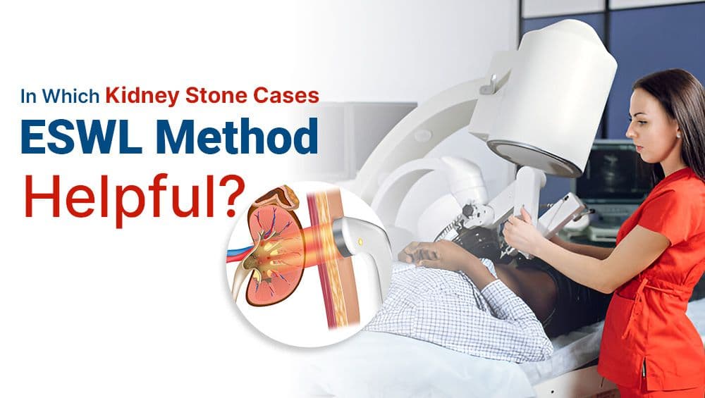 In Which Kidney Stone Cases is the ESWL Method Helpful?