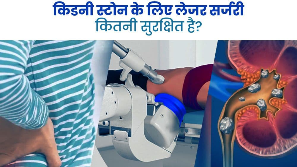 किडनी स्टोन के लिए लेज़र सर्जरी कितनी सुरक्षित है?