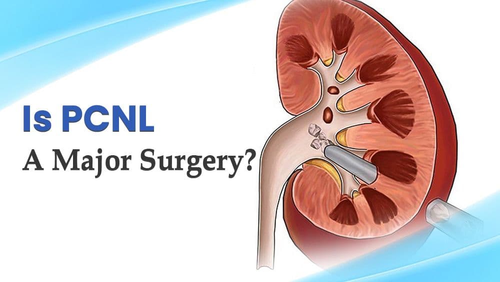 Is PCNL A Major Surgery?