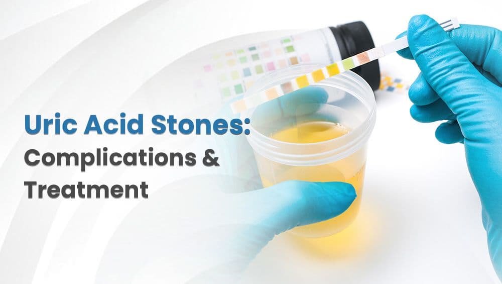 Uric Acid Stones: Complications & Treatment