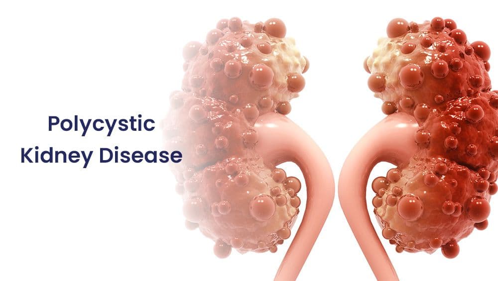 Polycystic Kidney Disease (PKD): What Is It?