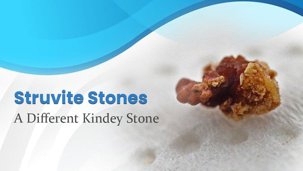Struvite Stones – A Different Kindey Stone