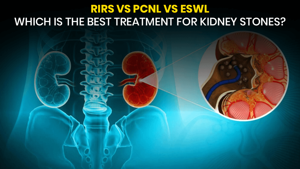 RIRS vs PCNL vs ESWL – Which is the best treatment for kidney stones?